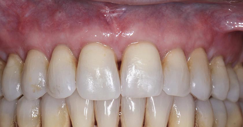 Gum graft upper – after treatment