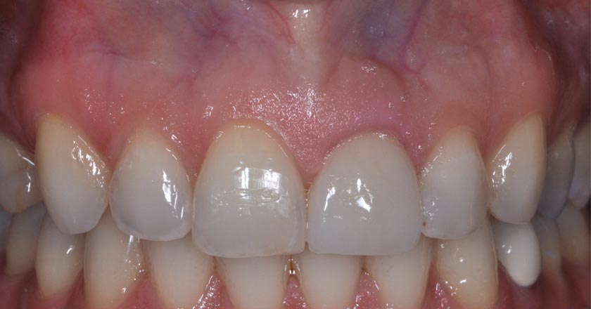 Dental implant – after procedure