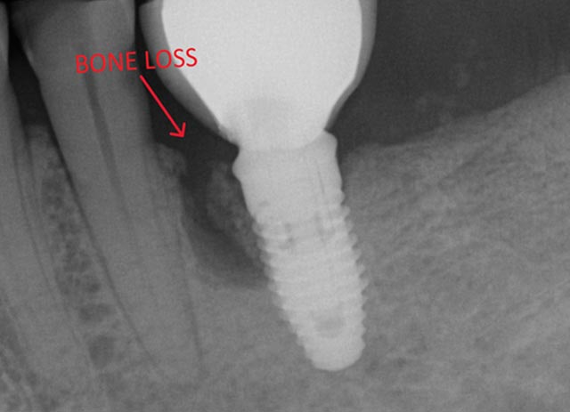 Implant bone grafting – before surgery