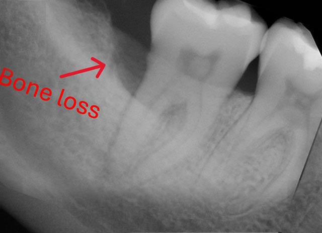 Tooth bone grafting – before procedure