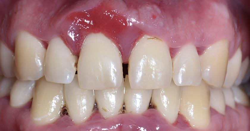 Gum disease scaling and root planing – before treatment