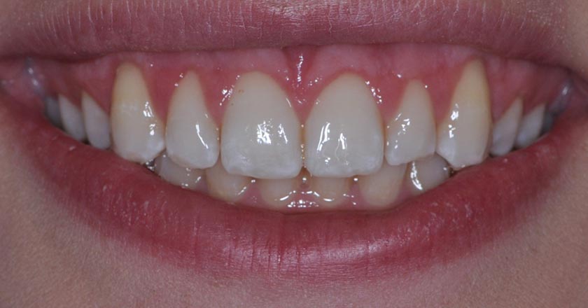 Gummy smile correction – after treatment 1