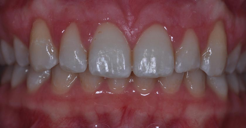 Gummy smile correction – after treatment 2