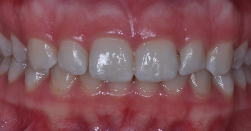 Gummy smile correction – before treatment 2